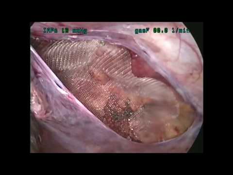hernioplastia - Reparación videoendoscópica de una Hernia Inguinal Derecha tipo indirecta utilizando la Vía Transabdominal Preperitoneal (TAPP). Colocación de malla no absor...