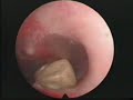 Cuerpo extraño en oído. Foreing body into external ear. Cuerpo extraño en oído. Foreing body into external ear.