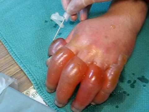 how to treat minor frostbite