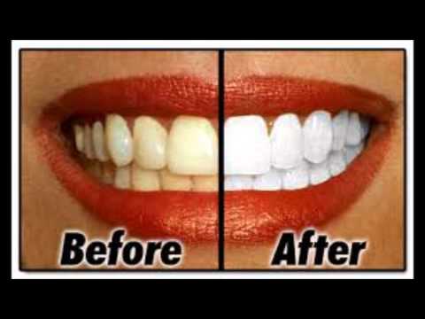 how to whiten exposed dentin