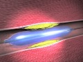 Teaching Science to Juries: Stent Litigation and Restenosis