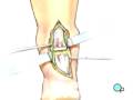 videos de Malpractice Medical Achilles Tendon Repair Surgery 3