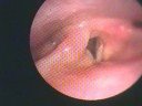 Vocal Fold Granuloma in Reflux Patient