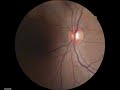 Optic Disc - Spontaneous Venous Pulsations