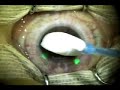 LASIK video Philippines