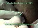 Follicular Unit Extraction or FUE Hair Transplant Follicular Unit Extraction or FUE Hair Transplant