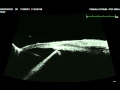 Eye Cubed&trade; Clinical Footage from Ellex 
