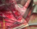 Carotid Endarterectomy