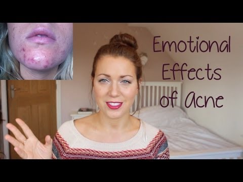 how to deal with acne