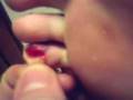 videos de Rotten toe