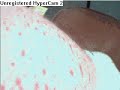 My leg with vasculitis Vasculitis