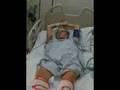 Brie in ICU for Guillain Barre Syndrome 2
