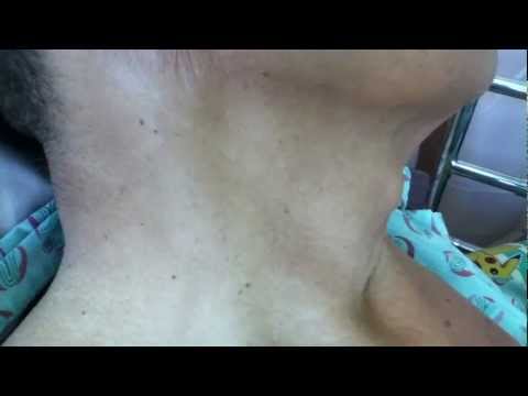 how to assess hepatojugular reflux