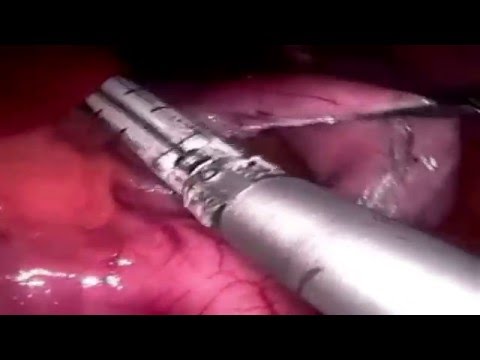 Κάθετη Μερική Γαστρεκτομή