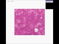 Histopathology Liver-- Alcoholic liver disease