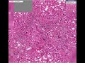 Histopathology Liver-- Alcoholic liver disease