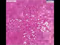 Histopathology Liver-- Alcoholic liver disease