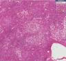 Histopathology Liver-- Alcoholic liver disease