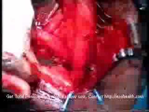 Penectomy -