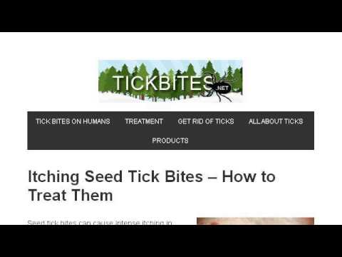 how to treat tick bites