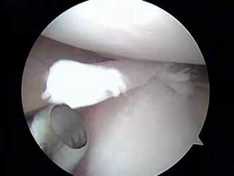 Meniscus (Cartilage) Surgery by Dr. ...