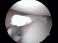 Meniscus (Cartilage) Surgery by Dr. Allan Mishra/Emedx.com