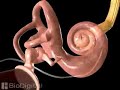 cochlear implant cochlear implant