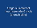 Tirage sus-sternal Tirage sus-sternal