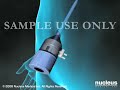 3D Medical Animation: Gallbladder Removal Surgery due to Gallstones