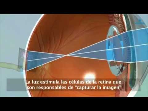 Retina - El desprendimiento de retina afecta anualmente a una de cada 10.000 personas. Se trata de un problema visual grave que puede ocurrir a cualquier edad, aunque...