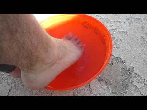how to cure athlete's foot