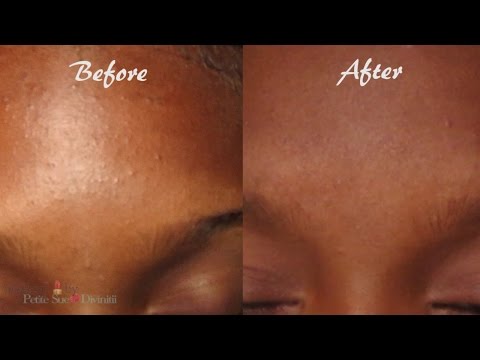 How to Reduce Acne & Breakouts!