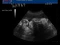 MORA de 34 semanas MORA de 34 semanas