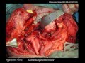 Advances in Radical Surgical Resection of Primary Spinal Tumors