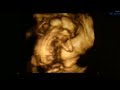 Ultrasound Week 15 Video