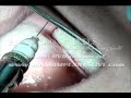 Comprehensive Implant Dentistry Live Training Courses at MiamiImplantsLive.com