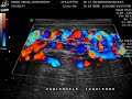 Varicocele
