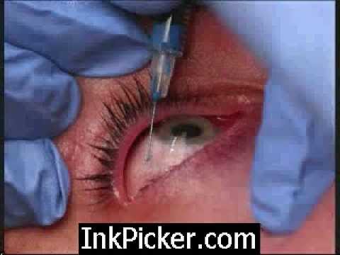 Watch this eyeball tattoo video and judge for.