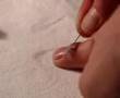 EBP-Brian's Finger Surgery