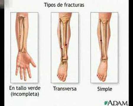 Fracturas A.S.S.