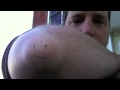 Caesar the Cyst