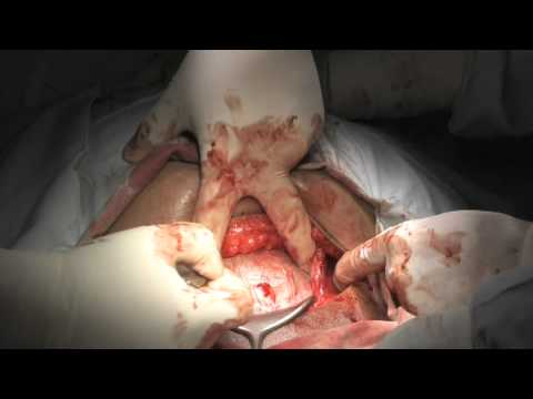 how to perform a c section on a goat