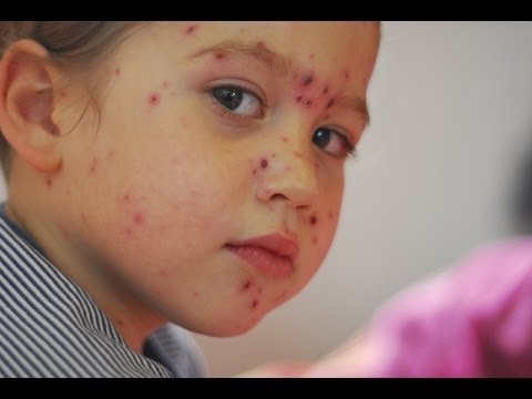 how to cure chicken pox naturally