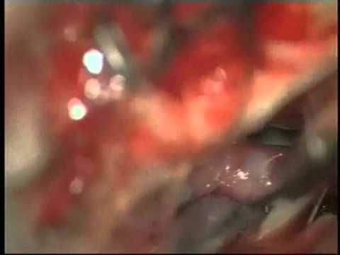 Previously Coiled Aneurysms Microsurgery - Experience on group of 81 patients - Video 6