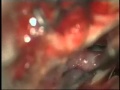 Microsurgery for Previously Coiled Aneurysms: Experience on 81 Patients: Video 6