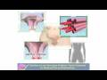 Animated video demonstrating how menstruation happens and how this often leads to painful menstrual cramps