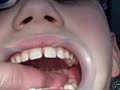 Getting My Braces! Stage 1 The Palate Expander