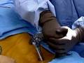Podcast: Minimally-Invasive Lumbar Fusion To Alleviate...