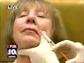 ArteFill - Amazing new wrinkle filler Collagen Replacement