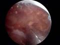 Dr. Dillingham removes suprapatellar plica from my knee